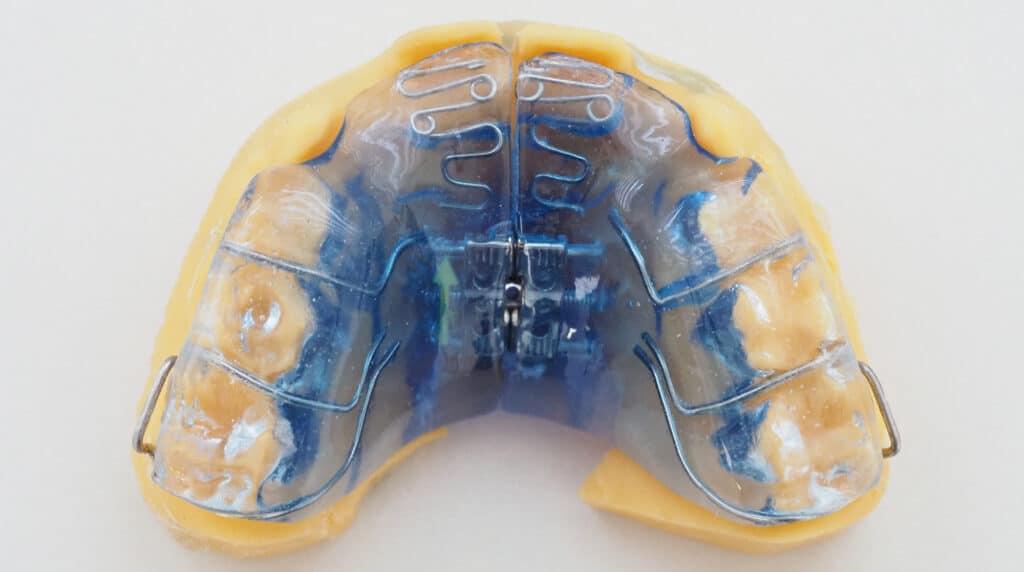 Plaque d'expansion maxillaire