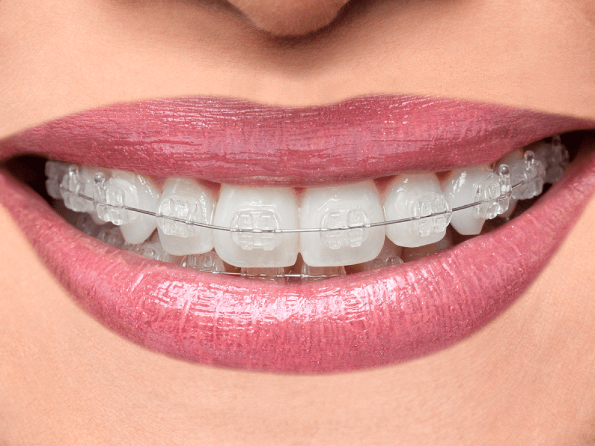 Multi-attaches c&eacute;ramiques