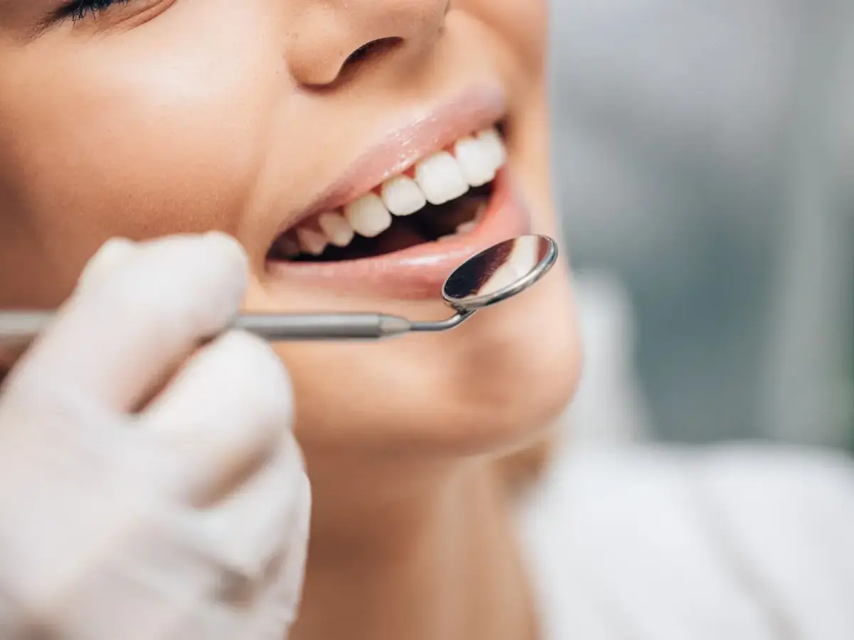 Facettes ou jaquettes dentaires ?